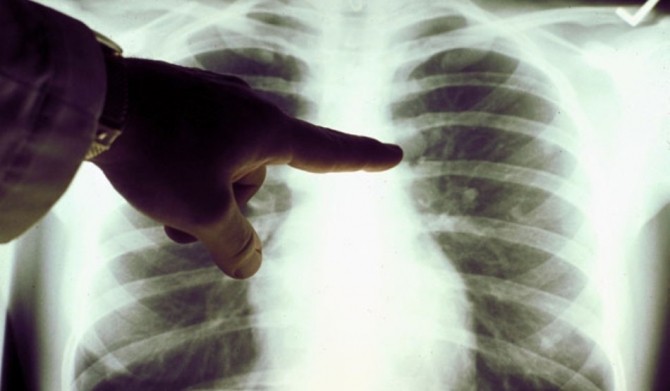 cancer-pulmonar