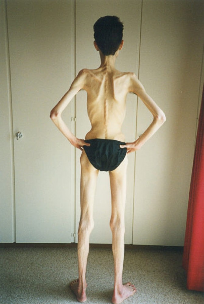 haircut recruit preposition Caz traumatizant. "Anorexia este singura mea prietenă"-FOTO | DCNews