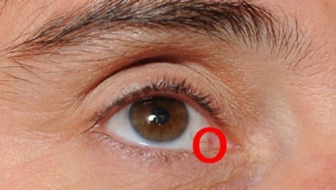 Bolile de ochi - cum sa recunosti afectiunile oftalmlogice