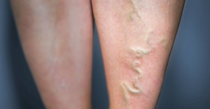 doare piciorul din cauza varicelor crema i ajuta la ajustarea cu varicoza