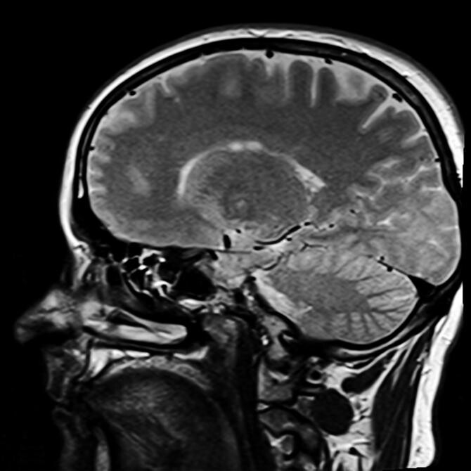 Studiu: Afecțiune neurologică rară, legată de infectarea cu SARS-CoV-2 în 21 de țări  /  Foto cu caracter ilustrativ: Pixabay