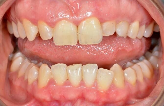 Avantaje implant dentar într-o zi