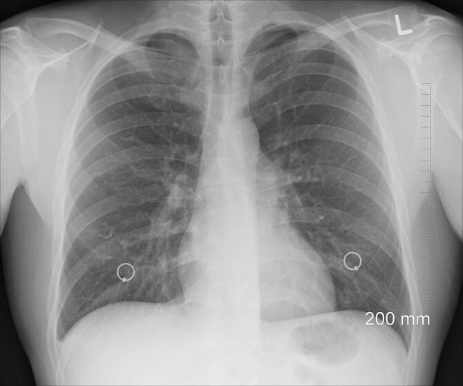 Mituri medicale despre cancerul pulmonar / Foto: Pixabay